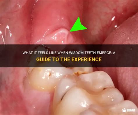 how does it feel when wisdom teeth come in