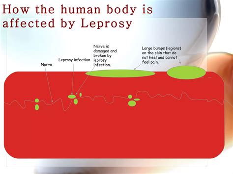 How Does Leprosy Affect The Body