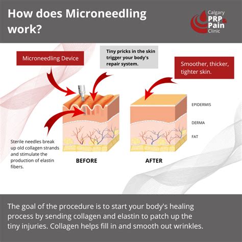 How Does Micro Needling Work