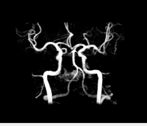 How Does Mra Work Without Contrast