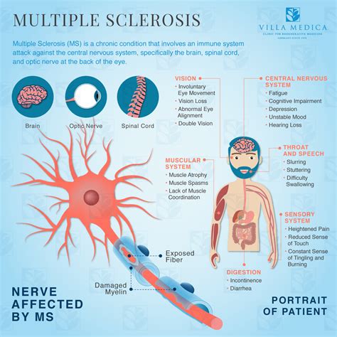 How Does Multiple Sclerosis Develop