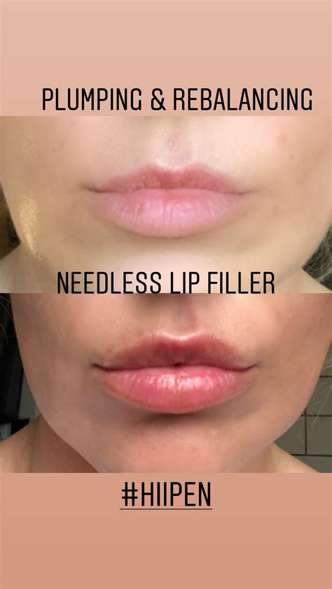 How Does Needle Free Lip Filler Work