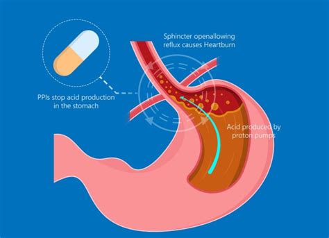 Understanding How Does Omeprazole Work for Acid Reflux Relief