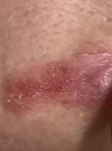how does perioral dermatitis.develop
