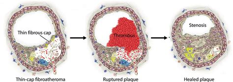 How Does Plaque Rupture
