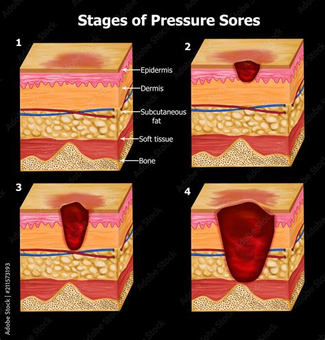 How Does Pressure Sores Form