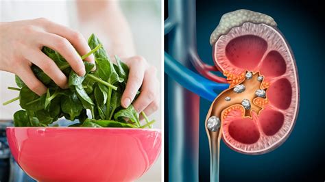How Does Spinach Affect Kidney Stones