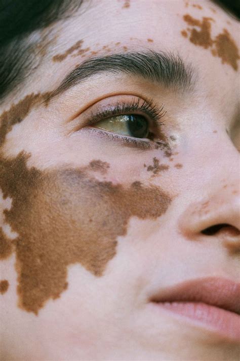 how does vitiligo spread
