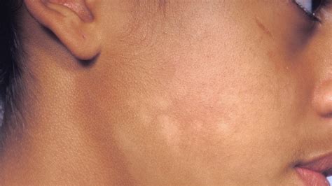 Understanding Vitiligo: How Does Vitiligo Start and Progress?