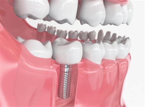 how effective are dental implants