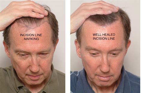 The How Effective Are Hair Transplants Reddit With Simple Style