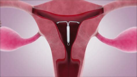 how effective are iud