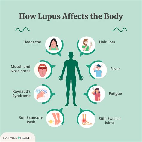 how fast can lupus develop
