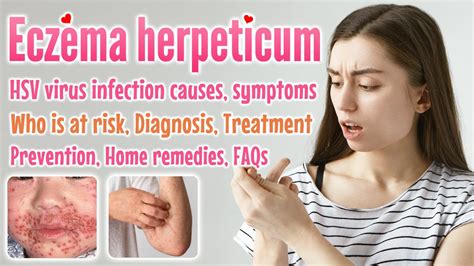 how fast does eczema herpeticum spread