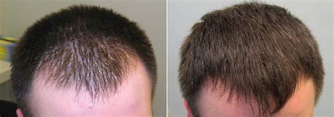 how finasteride works for hair loss