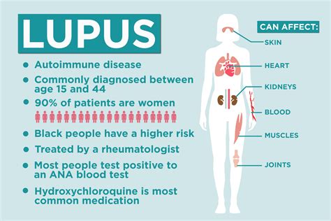 how hard is it to get diagnosed with lupus