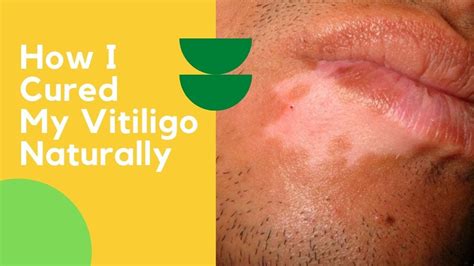 how i cured my vitiligo naturally