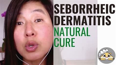 how i cured seborrheic dermatitis