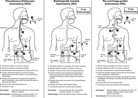 How Is A Rig Inserted