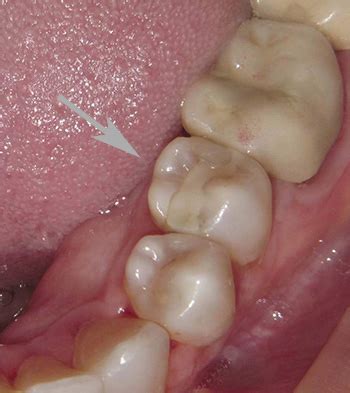 How Is A Temporary Filling Removed