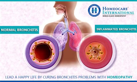 Understanding Bronchitis: How is Bronchitis Treated for Fast Relief