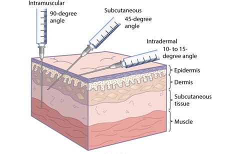 how is intradermal injection given