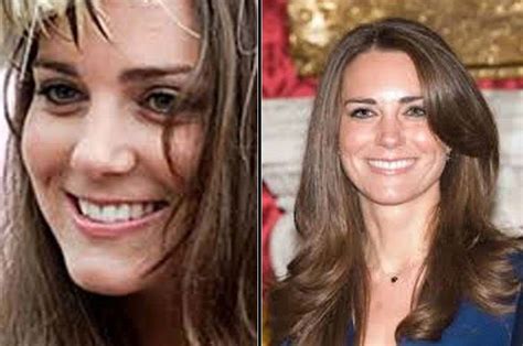 how is kate middleton doing after her surgery
