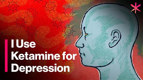 how is ketamine given for depression