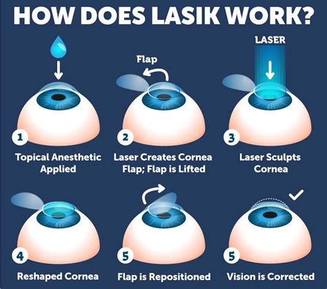 how is lasik eye surgery performed