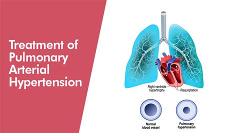 how is pulmonary hypertension treated