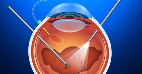 how is vitrectomy surgery performed