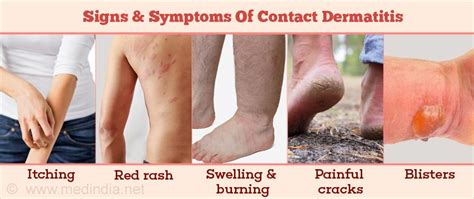 how itchy is contact dermatitis