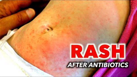 how long can a rash from antibiotics last