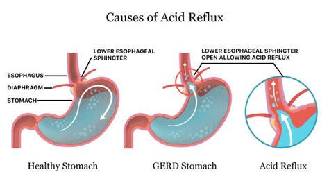 Understanding GERD: How Long Can GERD Last and What You Can Do About It