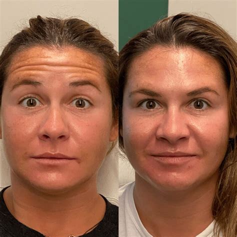 How Long Does It Take For Botox To Work For Sweating BOTOX