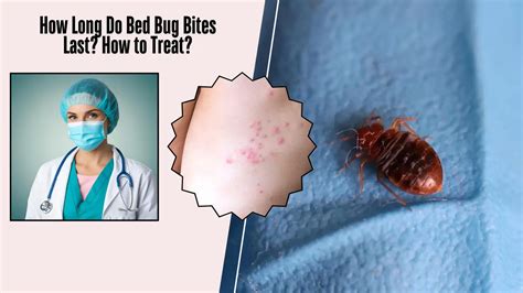 How Long Do Bed Bed Bug Bites Last