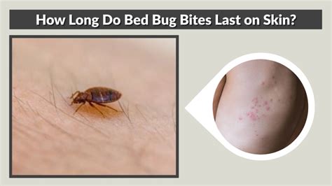 How Long Do Bed Bug Bites Keep Itching