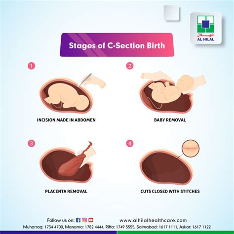 How Long Do C Sections Last