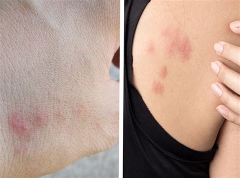 How Long Does A Bed Bug Itch Last