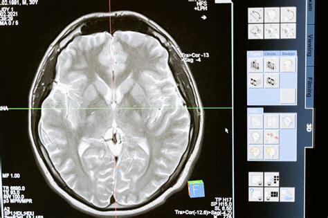how long does a brain cyst take to develop