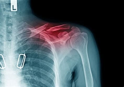 how long does a broken clavicle heal