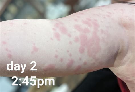 how long does a rash from amoxicillin take to go away