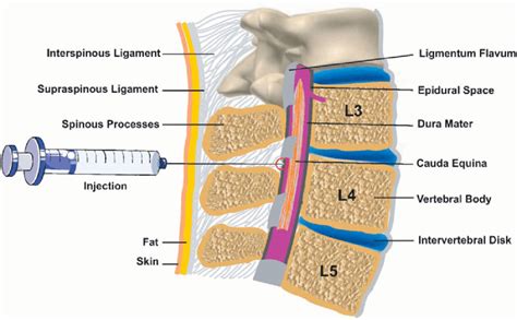 How Long Does A Spinal Anesthesia Last