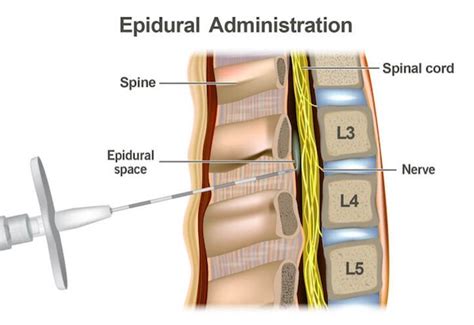 How Long Does A Spinal Injection Take To Work