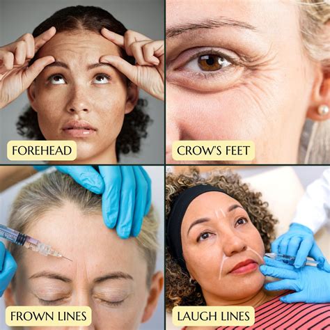 how long does botox take to become effective
