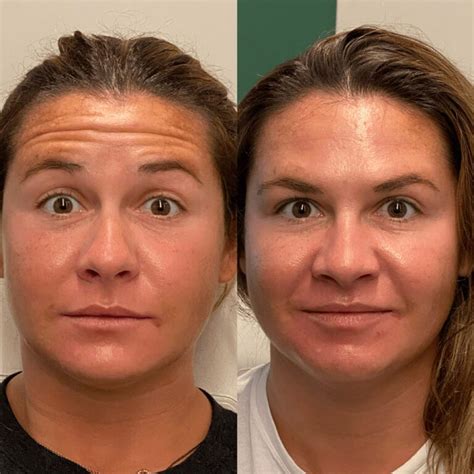 how long does botox take to work between eyebrows before