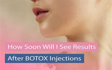 how long does botox take to work reddit