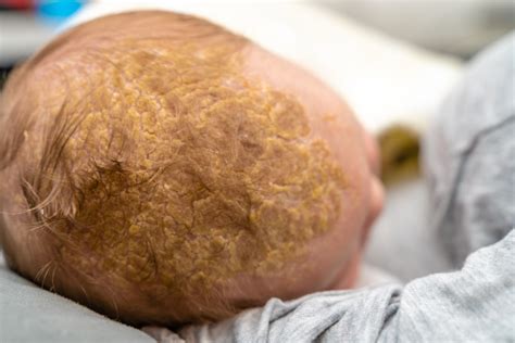 How Long Does Cradle Cap Take To Go