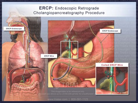 How Long Does Ercp Last