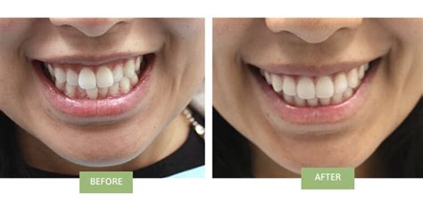 how long does invisalign take to fix crowded teeth